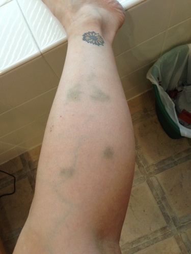 Bruised Leg Bruised Leg